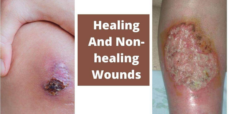 Healthy vs Infected Wound: Understanding the Differences