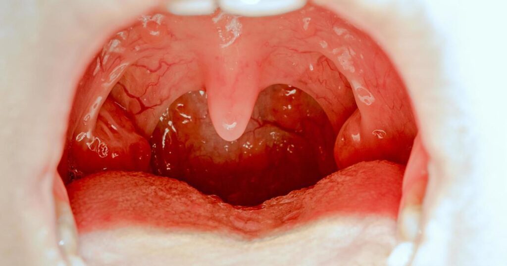 healthy tonsils vs unhealthy